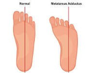 tibial torsion