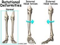 femoral anteversion